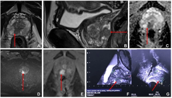 Study: Combination of Ultrasound and MRI-Targeted Biopsy Enhances Detection of Prostate Cancer