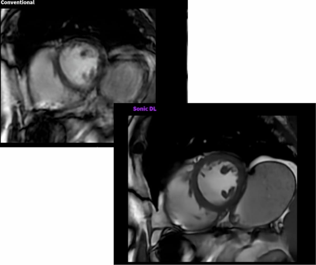 FDA Clears Cardiac AI Software That May Reduce MRI Scan Times by 83 Percent