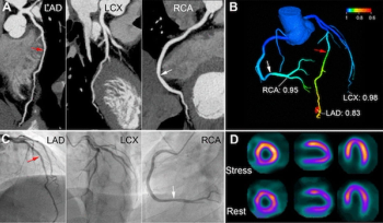 Study Shows Merits of CTA-Derived Quantitative Flow Ratio in Predicting MACE