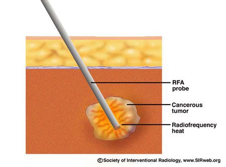 Patient Information: RFA Overview | Diagnostic Imaging