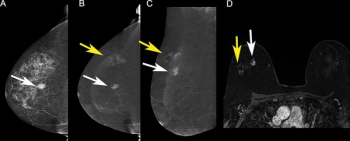 Ultravist Becomes First FDA-Approved Contrast Agent for Contrast-Enhanced Mammography