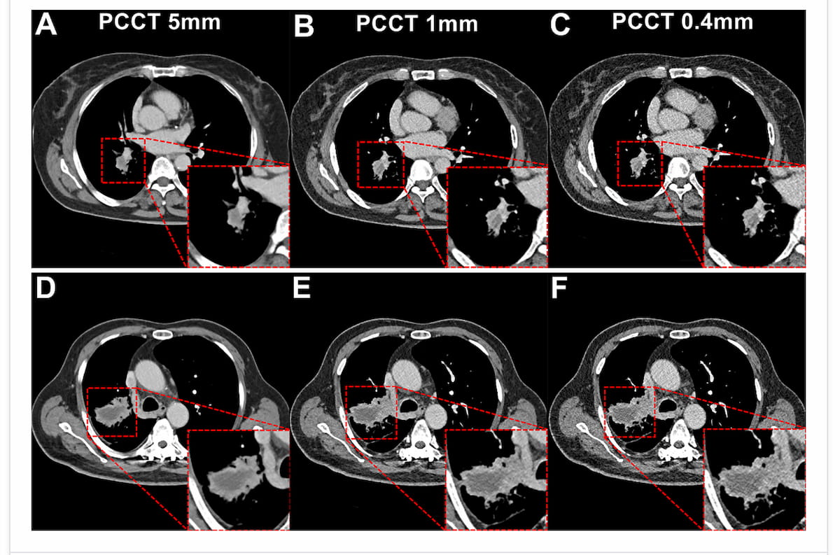 Study Shows Photon-Counting CT Reduces Radiation Exposure by 66 Percent for Patients with Lung Cancer