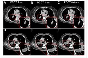 Study Shows Photon-Counting CT Reduces Radiation Exposure by 66 Percent for Patients with Lung Cancer