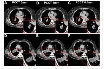 Study Shows Photon-Counting CT Reduces Radiation Exposure by 66 Percent for Patients with Lung Cancer