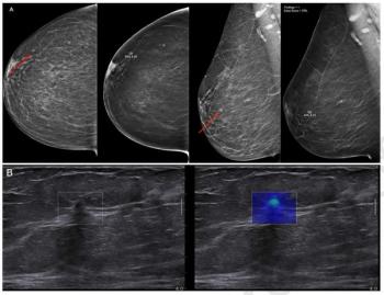 Large Mammography Study Shows AI-Aided DBT Bolsters Cancer Detection Without Increasing Recall Rate