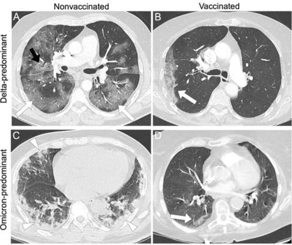 New chest CT study assesses impact of COVID-19 variants and vaccination status