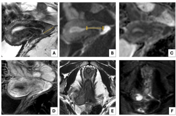 Ten Takeaways from New Guidelines on Pre-Op MRI for Fertility-Sparing Treatments of Cervical, Endometrial and Ovarian Cancer