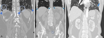Computed Tomography Study Finds Nearly 44 Percent of Interstitial Lung Abnormalities Are Not Reported