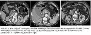 Multislice CT illuminatescholangiocarcinoma cases