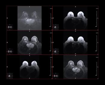 Study: White Women 11 Times More Likely than Black Women to Be Eligible for Supplemental Breast Cancer Screening in Pennsylvania