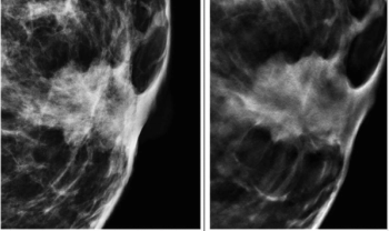 Mammography Study Finds No Additional Benefit with DBT in Women with Elevated Breast Cancer Risk