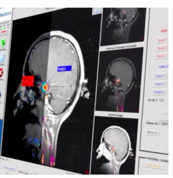 FDA Clears Enhanced MRI-Guided Laser Ablation System 