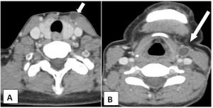 Complete Fistula of Third Branchial Cleft