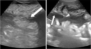 Pseudomyxoma Peritonnei