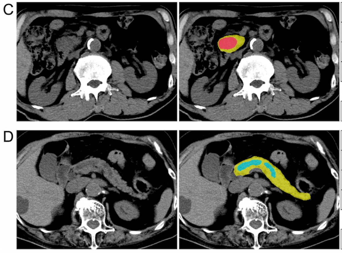 Can AI Enhance Non-Contrast and Contrast-Enhanced CT Detection of Pancreatic Cancer?