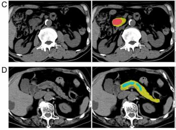 Can AI Enhance Non-Contrast and Contrast-Enhanced CT Detection of Pancreatic Cancer?