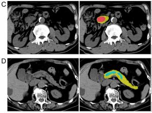 Can AI Enhance Non-Contrast and Contrast-Enhanced CT Detection of Pancreatic Cancer?