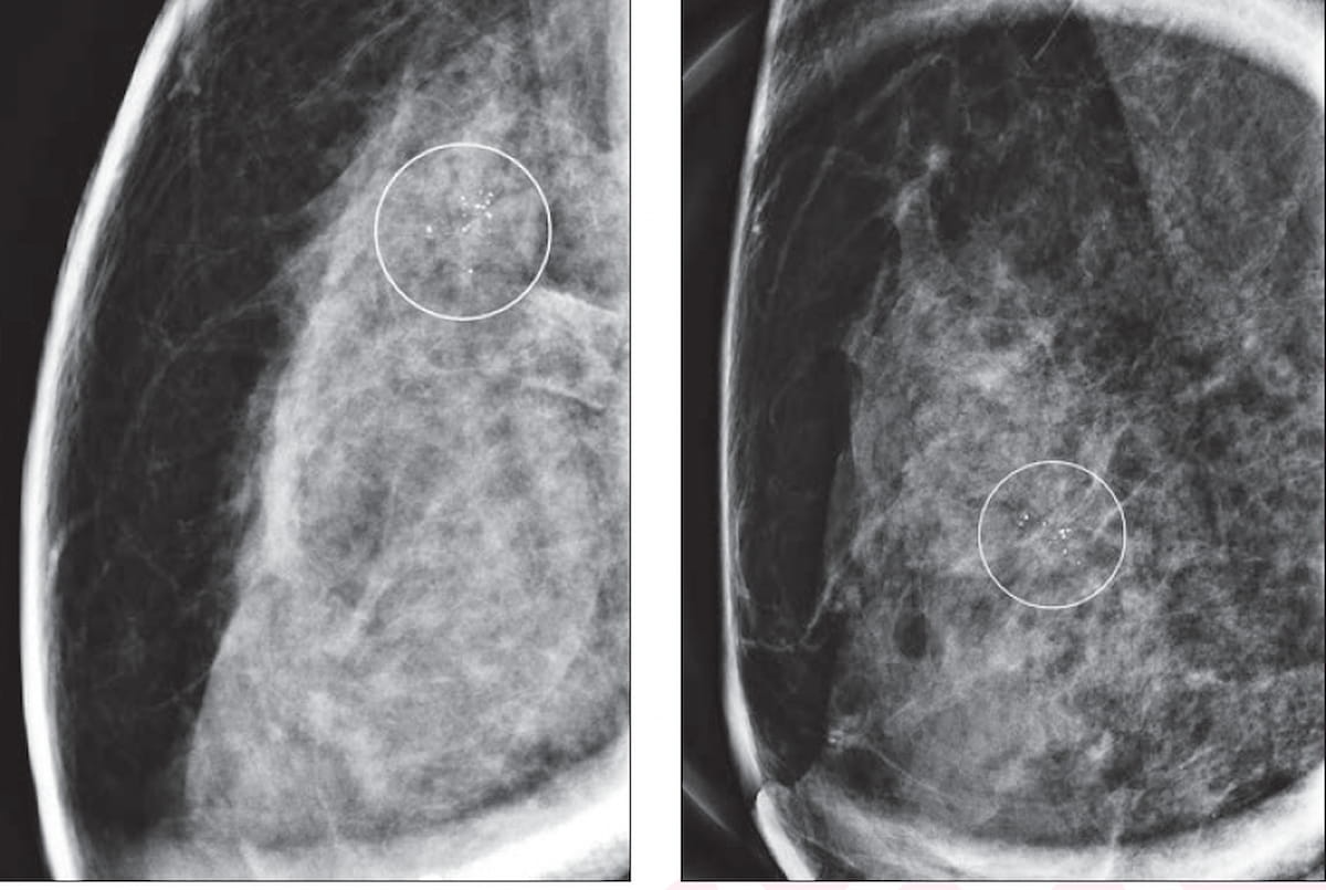 Scar Gamma Radiography What New Mammography Research Reveals About Radial Scars Detected with ...