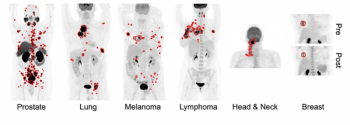SNMMI: AI May Enhance Detection and Risk Assessment for Multiple Cancers on Whole-Body PET/CT Scans