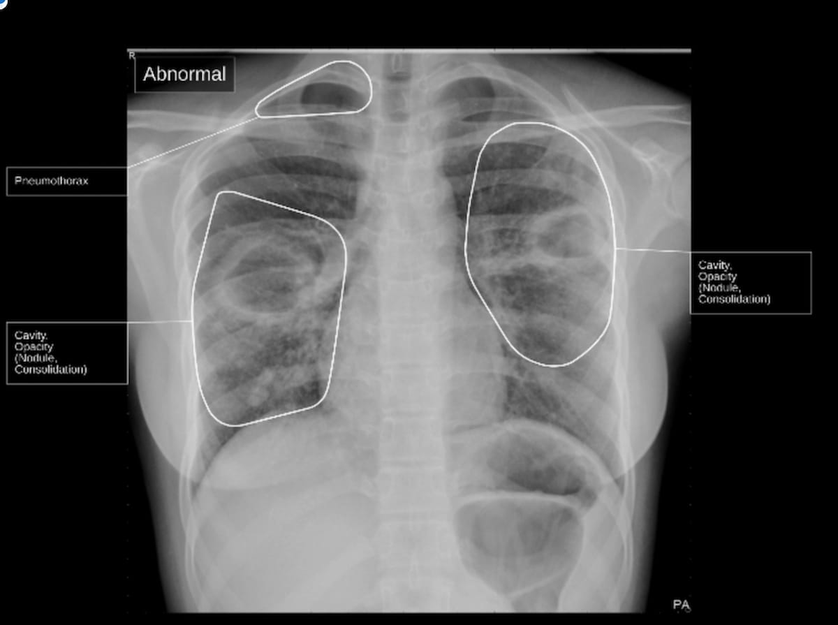Adjunctive AI-Powered Tool for Tuberculosis Detection Gets FDA’s Breakthrough Device Designation
