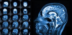 Can Brain MRI Surveillance Alone Be Advantageous in Monitoring Cognition for Patients with SCLC? 