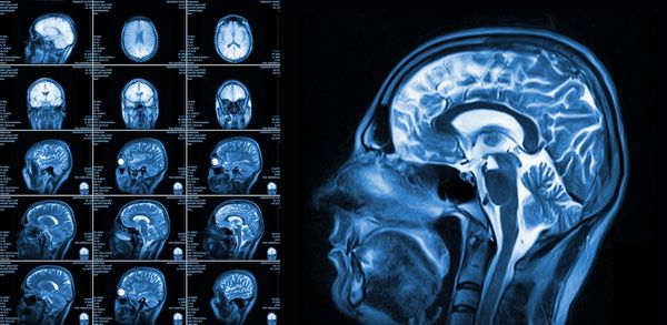 Can Brain MRI Surveillance Alone Be Advantageous in Monitoring Cognition for Patients with SCLC? 