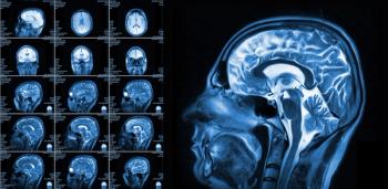 Can Brain MRI Surveillance Alone Be Advantageous in Monitoring Cognition for Patients with SCLC?