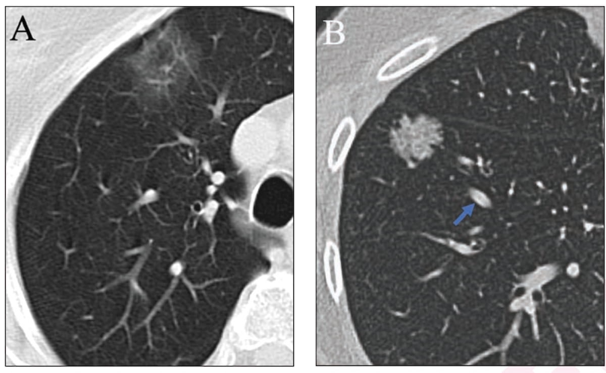 What Emerging CT Research Reveals About Pure Ground Glass Nodules