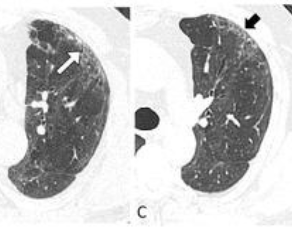 CT Study Reveals Persistent Abnormalities Two Years After COVID-19