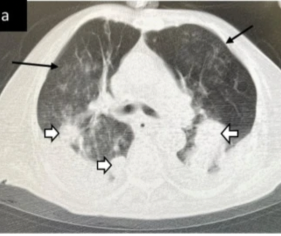COVID-19 and Cancer: What a New Chest CT Study Reveals