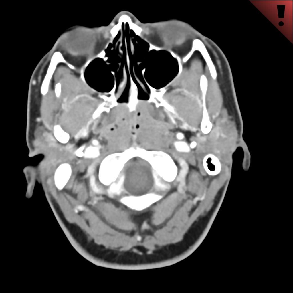 Image IQ Possible Adenopathy Image iq possible adenopathy