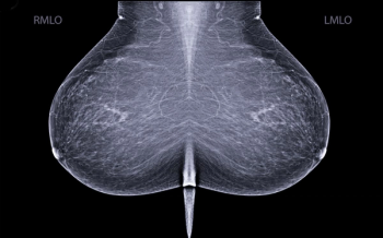 Should Race and Ethnicity Factor into Starting Ages for Mammography Screening?