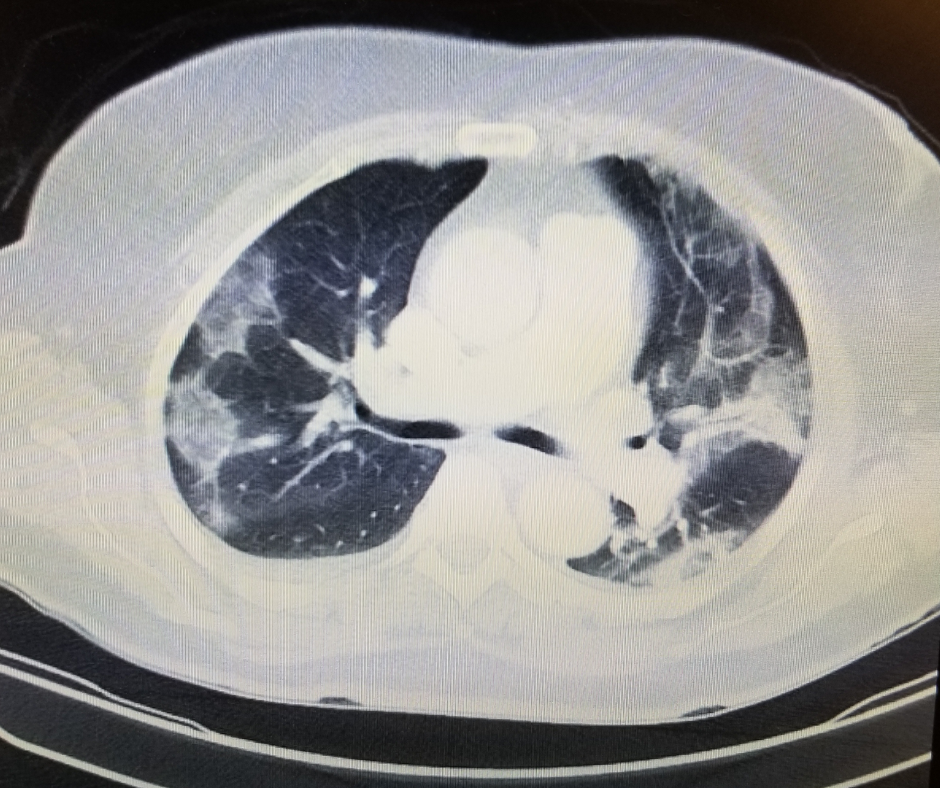 How Accurate is the CT Severity Score for Predicting COVID-19 Severity?