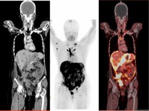 Is FAPI PET More Advantageous Than CECT for Detecting Peritoneal Carcinomatosis in Patients with Ovarian Cancer?