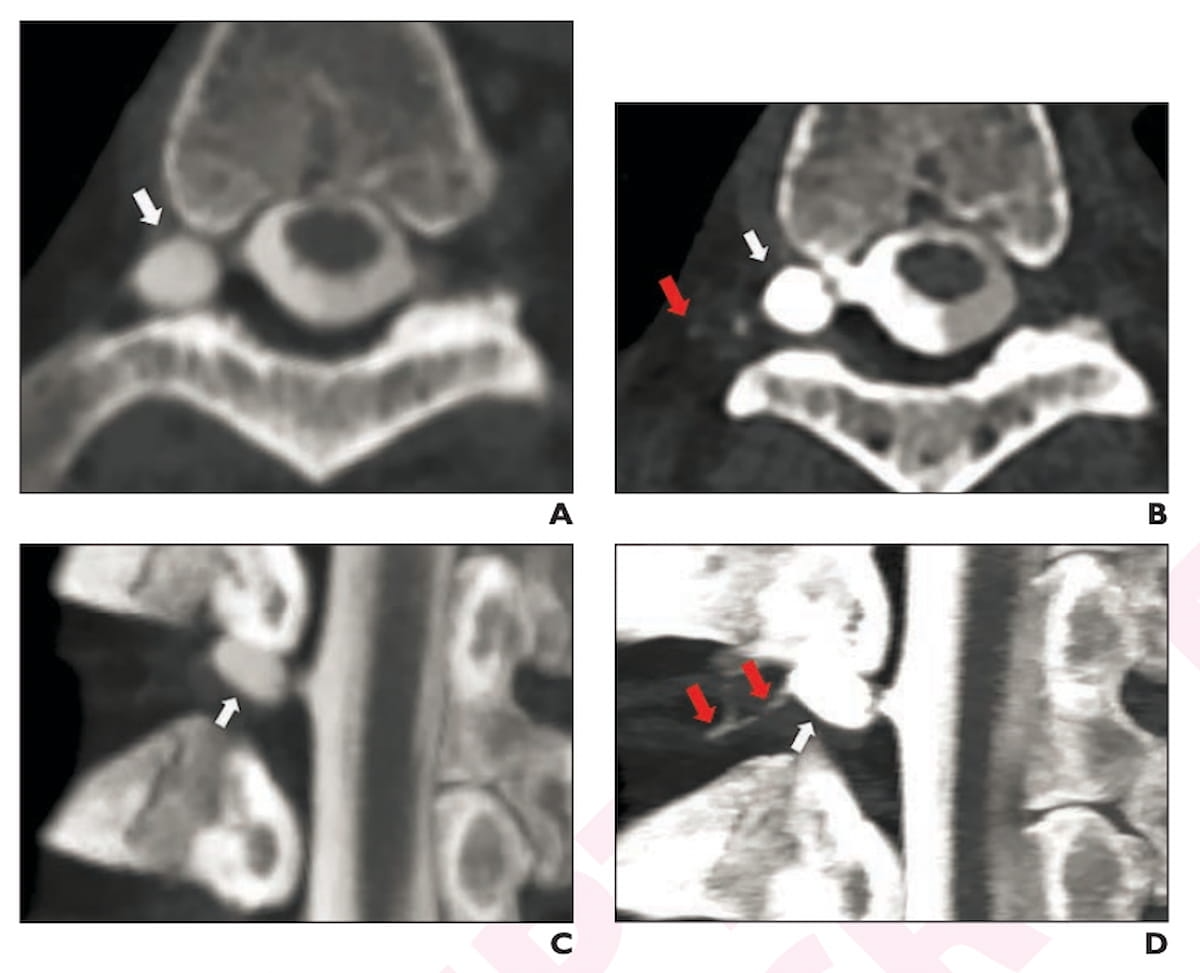 Photon Counting CT May Facilitate Earlier Diagnosis of Spontaneous Intracranial Hypotension