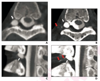 Photon Counting CT May Facilitate Earlier Diagnosis of Spontaneous Intracranial Hypotension