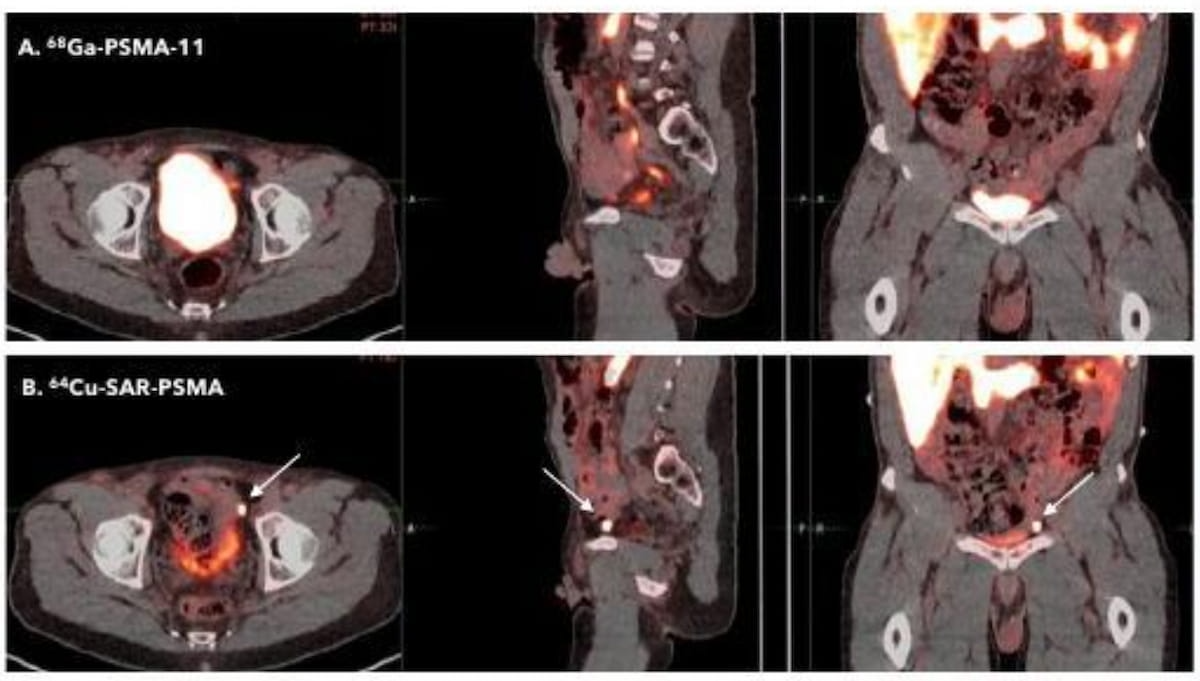 Psma Emerging PSMA PET Agent May Offer Improved Detection of Prostate Cancer ...