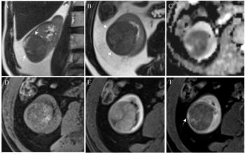 Study Shows Impact of Key mpMRI Features for Enhancing Assessment of Renal Masses