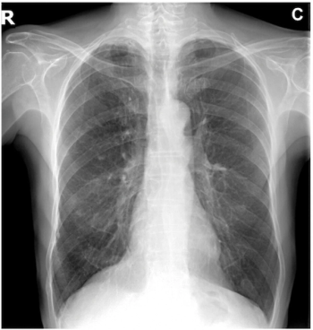 Study: Generative AI Model Reduces CXR Reading Time by 42 Percent