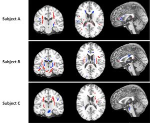 Imaging Technique Shows Brain Can Heal After Injury