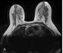 Can MRI Provide Greater Clarity of Suspected BI-RADS 3 Lesions?