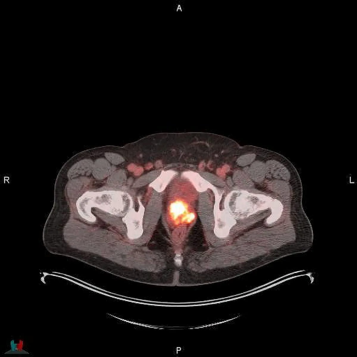Study: 18F-Flotufolastat PET Imaging Changes Treatment in 89 Percent of Patients with Prostate Cancer Recurrence