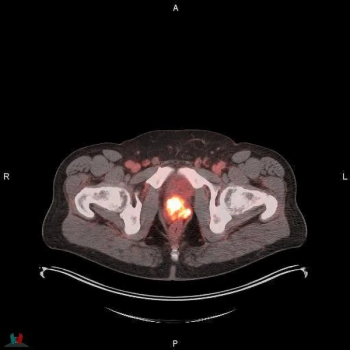 Study: 18F-Flotufolastat PET Imaging Changes Treatment in 89 Percent of Patients with Prostate Cancer Recurrence