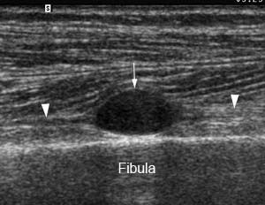 Effective peripheral nerve imaging can improve quality of life
