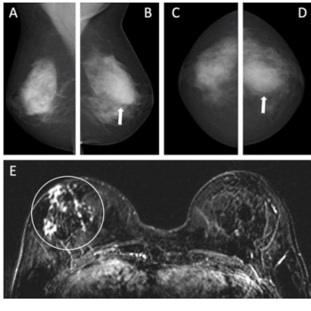 Can Mammography-Based AI Enhance Breast MRI Use in Patients with Intermediate Risk for Breast Cancer?