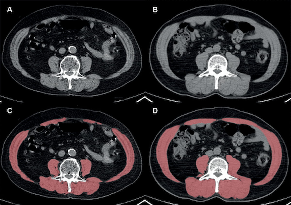 What Emerging CT Research Reveals About Obesity and Post-Op Survival for Non-Small Cell Lung Cancer