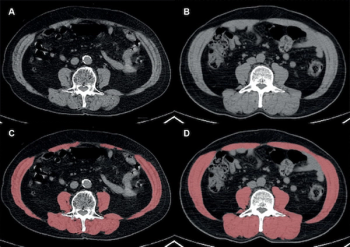 What Emerging CT Research Reveals About Obesity and Post-Op Survival for Non-Small Cell Lung Cancer