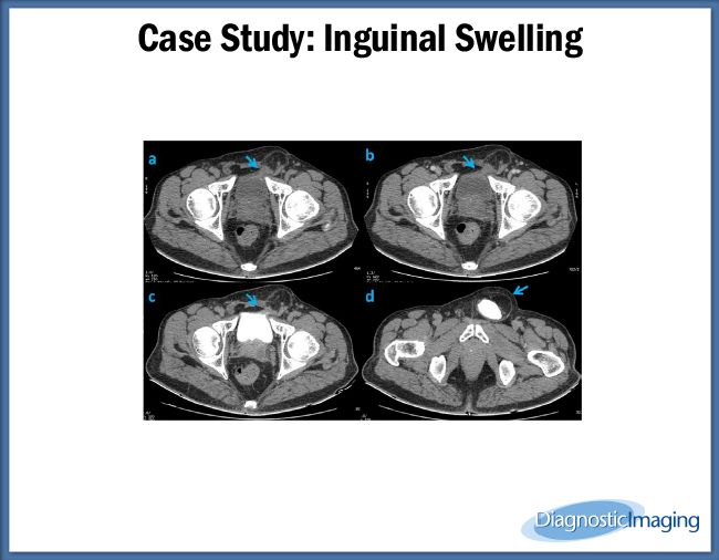 Inguinal Ligament Swelling