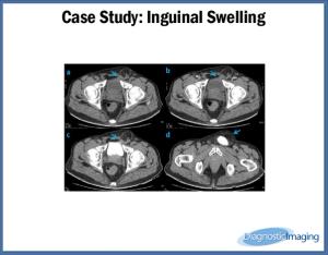 Inguinal Swelling