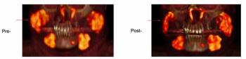 SNMMI: Botox May Facilitate Relief from Dry Mouth Side Effect of PSMA-Targeted Radiopharmaceuticals